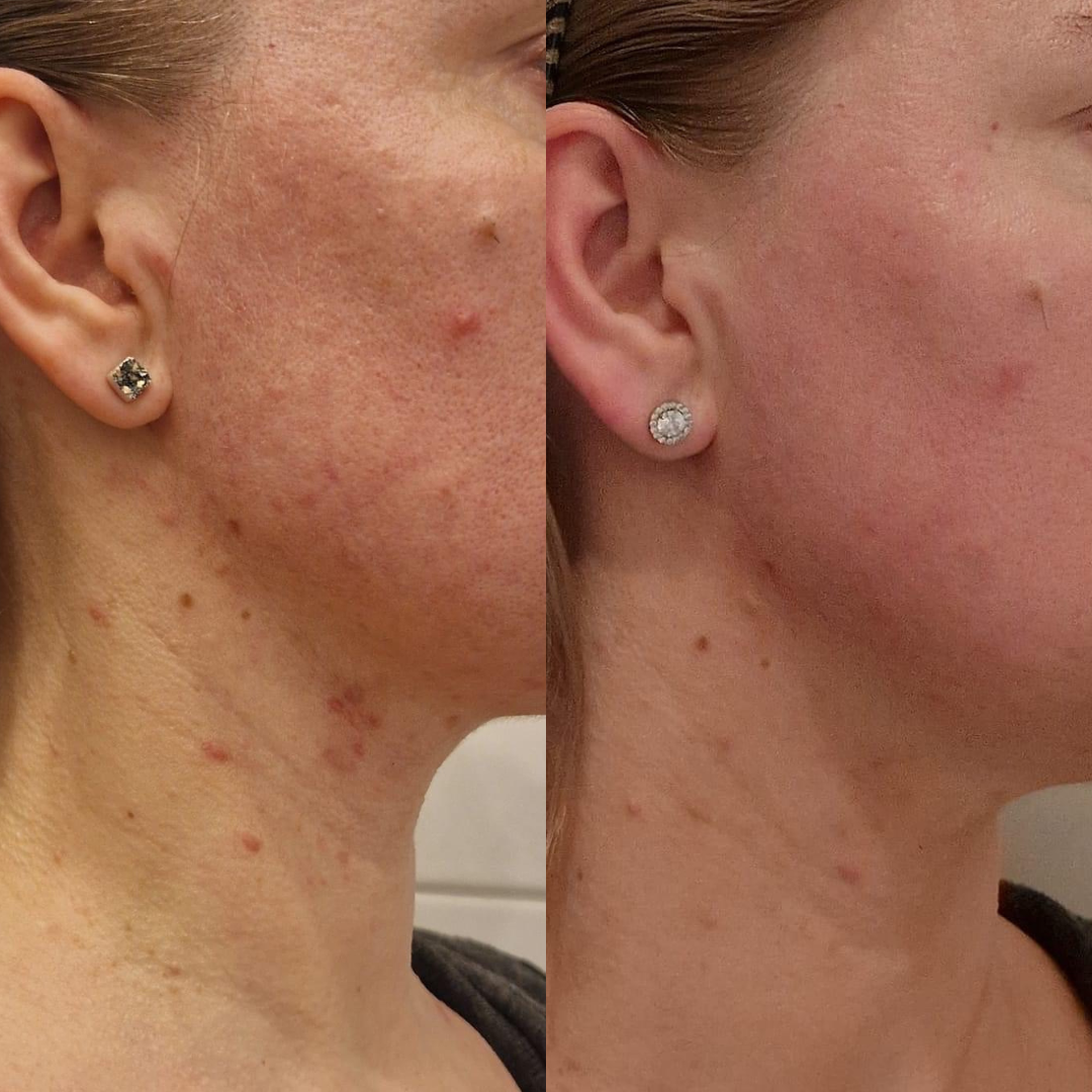 Acne/Treatment procedūra